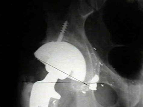 THR: Acetabular Reaming : Wheeless' Textbook of .